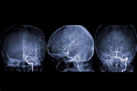 Cerebral Angiography Image From Fluoroscopy In Intervention Radiology