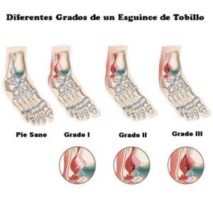 El Esguince De Tobillo Apr Ndelo Todo Ortopedia Para Ti