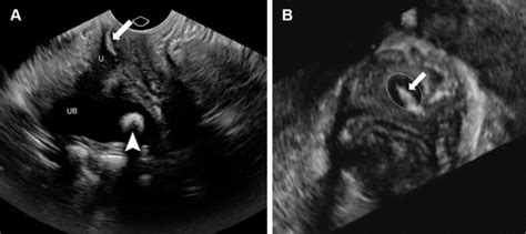 Multimodality Imaging Of Anterior Compartment Pelvic Floor Repair