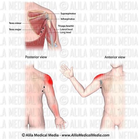 Alila Medical Media Trigger Points And Referred Pain Patterns For The