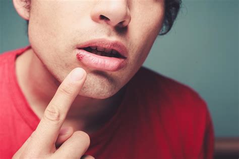 Herpes Labiales Causas Síntomas Y Tratamiento