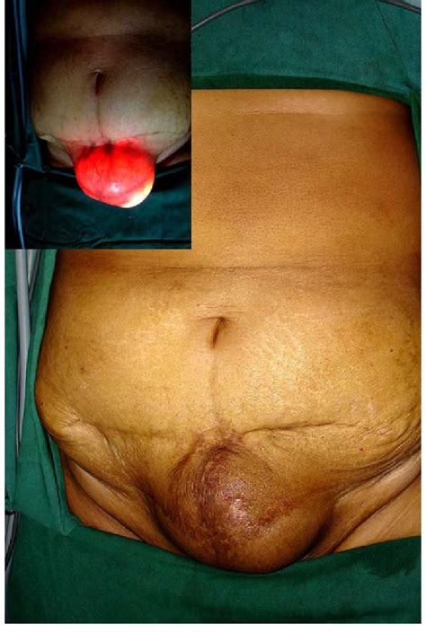 External View Of The Suprapubic Hernia Insetafter Co Insuzation