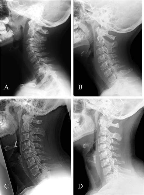 Cervical lordosis: the effect of age and gender - The Spine Journal