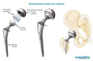 Reemplazo Total De Cadera En Qu Consiste La Operaci N