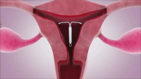 IUD most effective birth control method, Canadian pediatricians declare ...