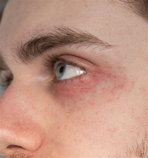 Perioral Dermatitis Around Eyes