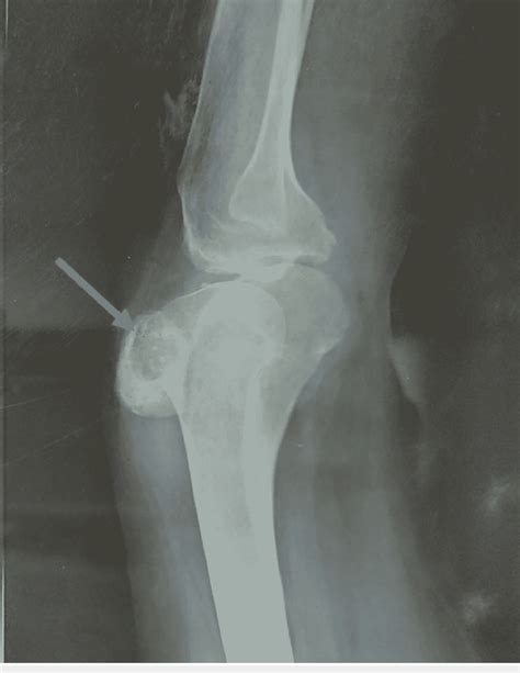 Lateral X Ray Of The Knee Demonstrating Localized Lytic Lesion In The