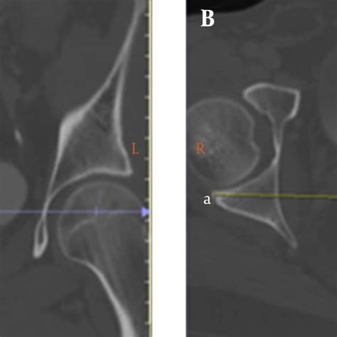 acetabular version angle  reference plane  acetabular version
