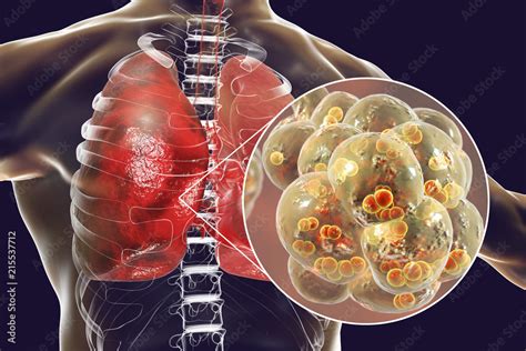 Pneumococcal Pneumonia Medical Concept 3D Illustration Showing