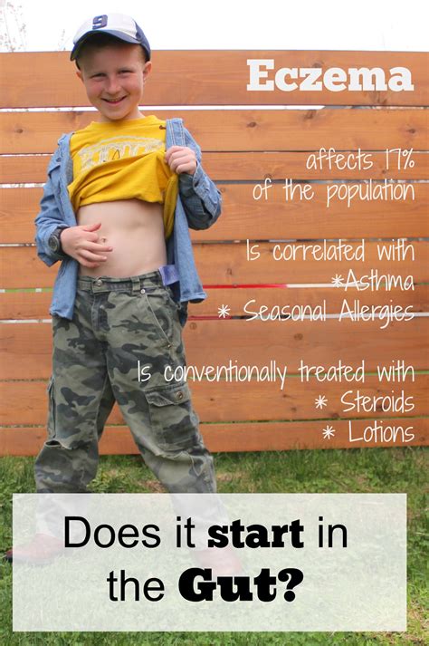 Eczema Causes Gut at James Kornweibel blog