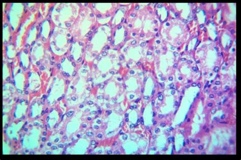 Photomicrograph Of Tgi Showing Extensive Hydropic Degeneration Black