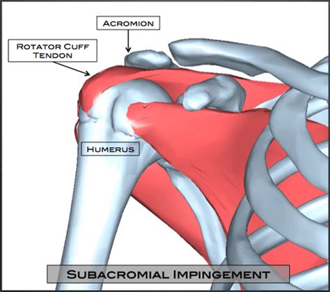 Subacromial Injection