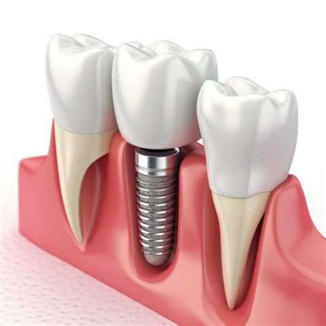 The Ultimate Guide To Dental Implants Costs Benefits And More