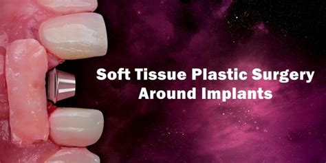 Soft Tissue Plastic Surgery Around Implants Online Dental Library