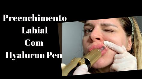 Preenchimento Labial Com Hyaluron Pen Youtube