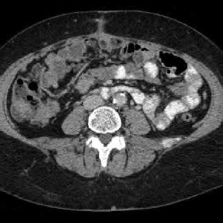 A Follow Up Computed Tomography Scan Of The Abdomen And True Pelvis