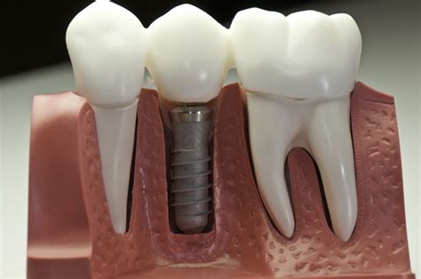 Are Dental Implants A Safe Procedure