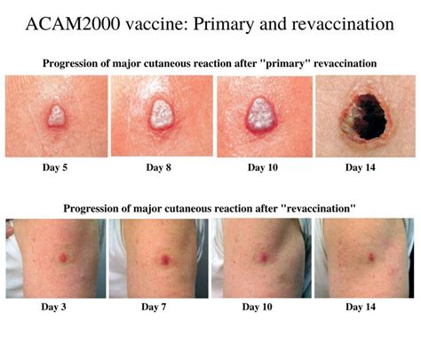 Monkeypox Vaccines What To Know About Imvamune Imvanex Jynneos