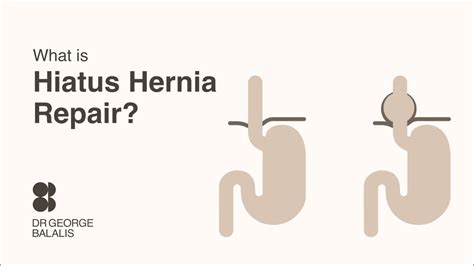 Dr George Balalis What Is Hiatus Hernia Repair YouTube