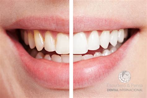 En Que Consiste El Blanqueamiento Dental Centro Dental