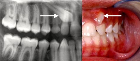 impacted-canine-3md - Pacific Oral Surgery