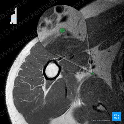 Thoracodorsal artery: Anatomy, branches, supply | Kenhub