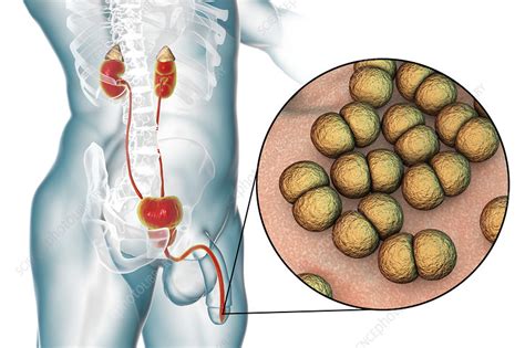 Gonorrhoea Infection In Male Illustration Stock Image F022 8360