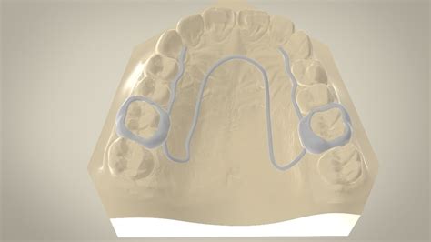 3d Printed Digital W Arch Appliance Orthodontic Appliance By Labmagic