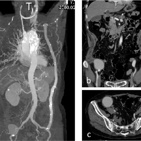 Preoperative Contrast Enhanced Ct A The Left External Iliac