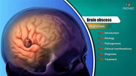 Brain Abscess Etiology Pathogenesis Clinical Manifestations Diag Manifestation