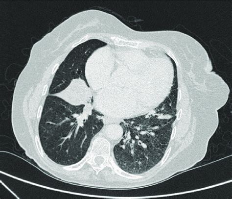 -CT thorax scan showing a right middle lobe collapse. | Download Scientific Diagram