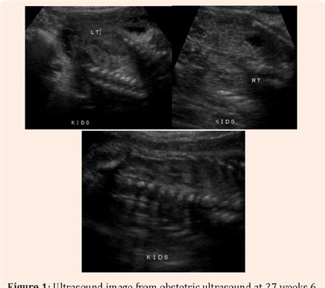 Figure 1 From Wolf Hirschhorn Syndrome Whs A Case Report And Review