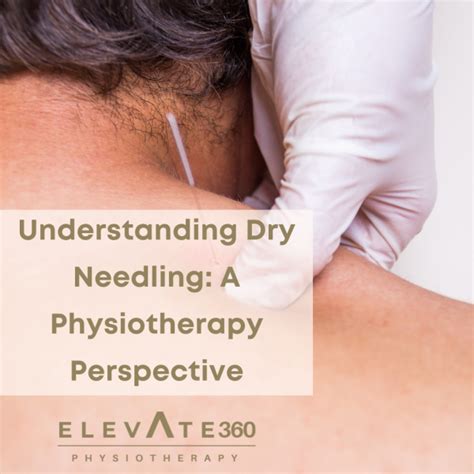 Understanding Dry Needling A Physiotherapy Perspective Elevate