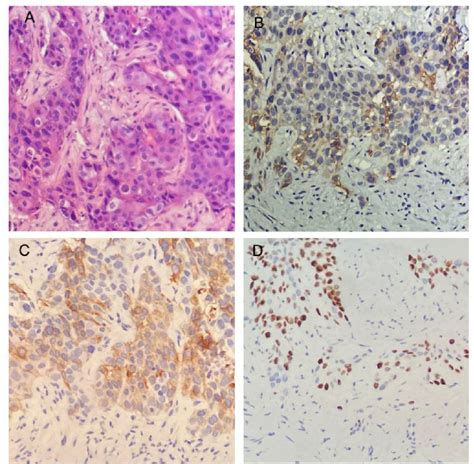 Figure 1 From Squamous Cell Carcinoma Of Ascending Colon With Pmmr Mss Showed A Partial Response