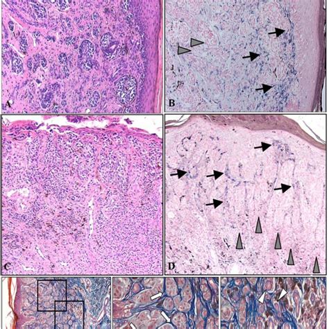 Type I Collagen Turn Over In Human Melanoma Type I Collagen