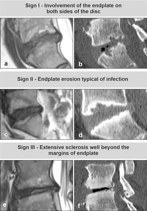 Signs specific to infection. The figure demonstrates three signs ...