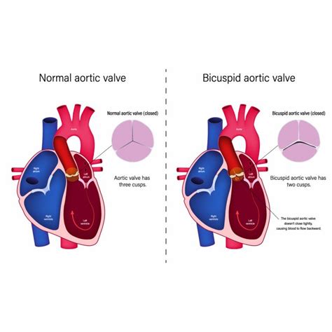 8 Common Symptoms For Aortic Valve Regurgitation Vejthani