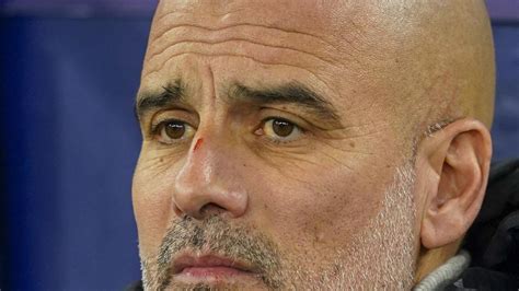 Soal Luka Di Hidung Saat Man City Ditahan Feyenoord Pep Guardiola