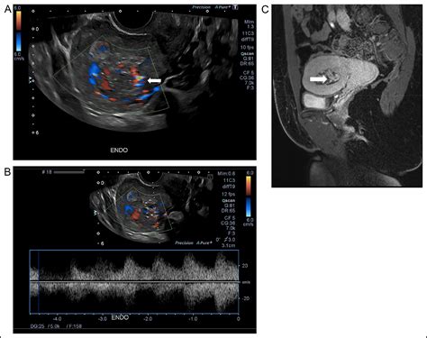 Clinical Conundrum A 39 Year Old With Chronic Retained Products Of