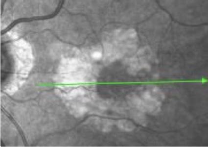 Geographic Atrophy How To Diagnose Ga When To Refer