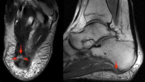 plantar aponeurosis | coachingultrasound