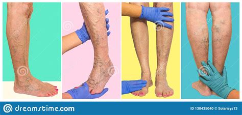 The Female Legs With Veins Varicose Spider Collage Stock Photo Image