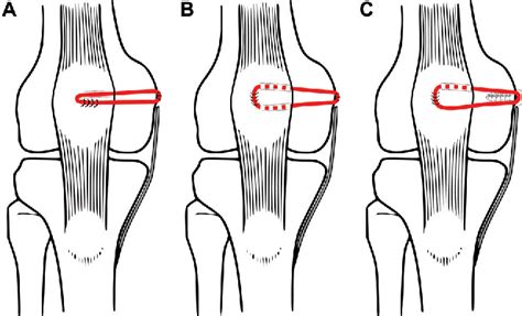 Figure 2 From Patellofemoral Pressure Changes After Static And Dynamic