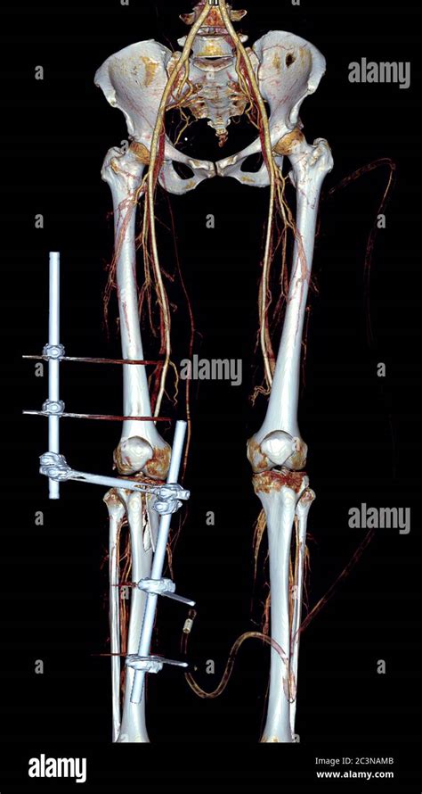 Beinarterie In Fotos Und Bildmaterial In Hoher Aufl Sung Alamy