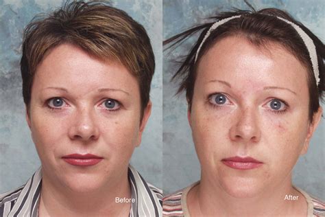 Botox Eye Brow Lift Before And After Eyebrow Lift Using Botox Eyelid