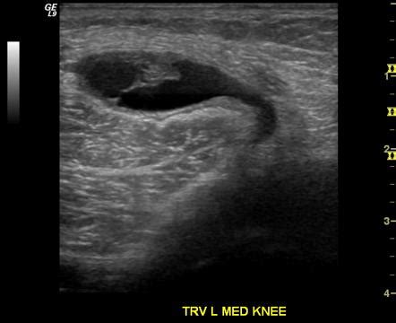 Baker Cyst Aspiration Radiology Case Radiopaedia Org