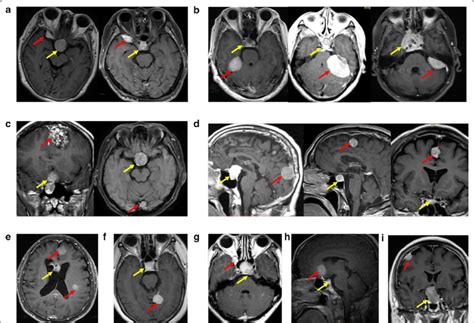 Pituitary Adenoma Associated With Meningioma Which Located Different