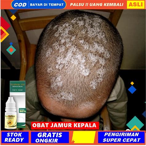 Jual Obat Psioriasis Kulit Kepala Obat Kulit Kepala Gatal Parah Obat