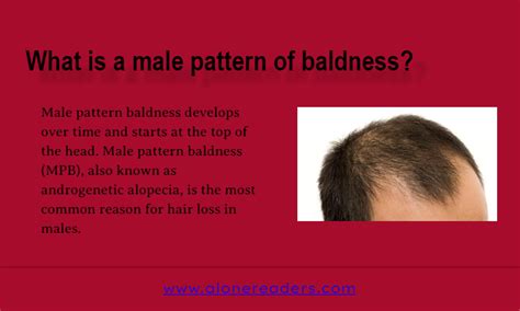 What Is A Male Pattern Of Baldness