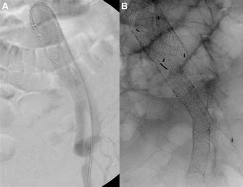 Hepatorenal Syndrome From An Ilio Iliac Arteriovenous Fistula A Rare